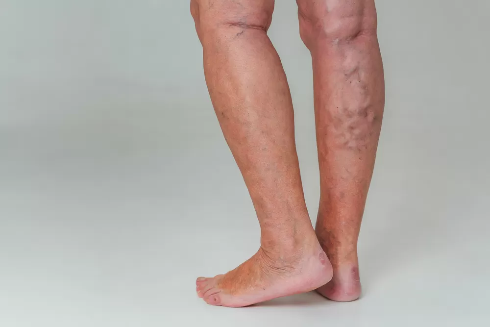 Derin Toplardamar Tıkanıklığı Belirtileri