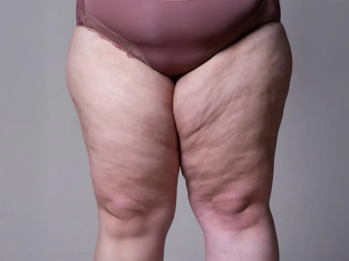 ankara lipodem doktoru secimi